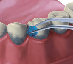 Zahnreinigung Einfärben der Beläge