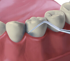 Zahnreinigung Entfernung von Zahnstein