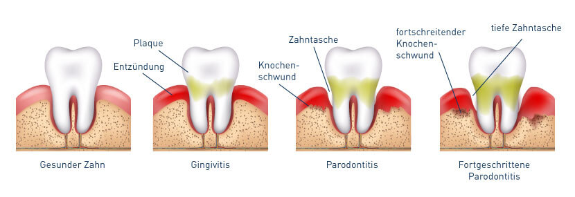 Folgen einer Zahnfleischentzündung