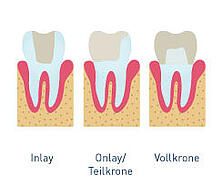 Inlay Onlay Krone