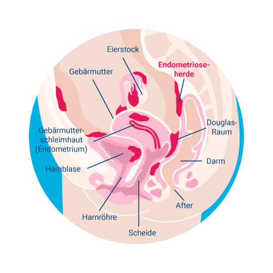Darstellung möglicher Endometriose-Herde