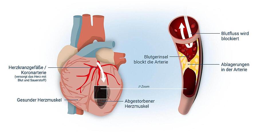 Herzinfarkt Myokardinfarkt Ursachen Symptome Behandlung