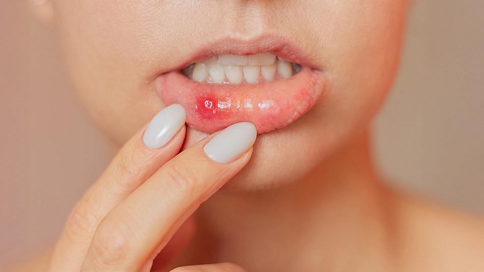 Stomatitis