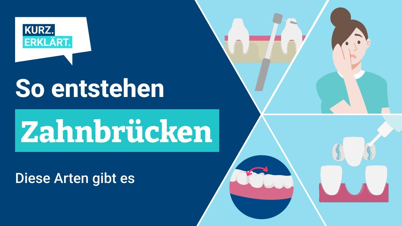Zahnbrücken: Alles, was Du dazu wissen musst - kurz erklärt!