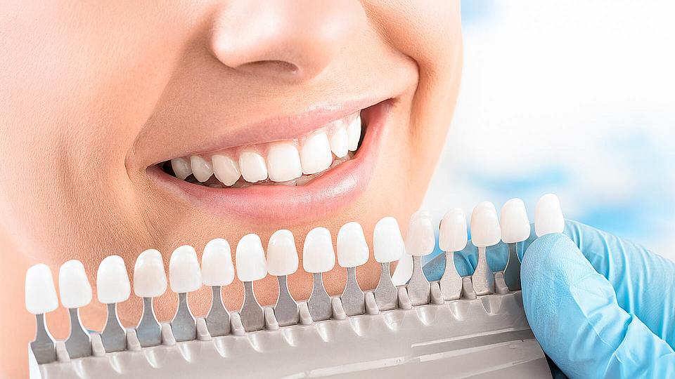 Veneers Veneers