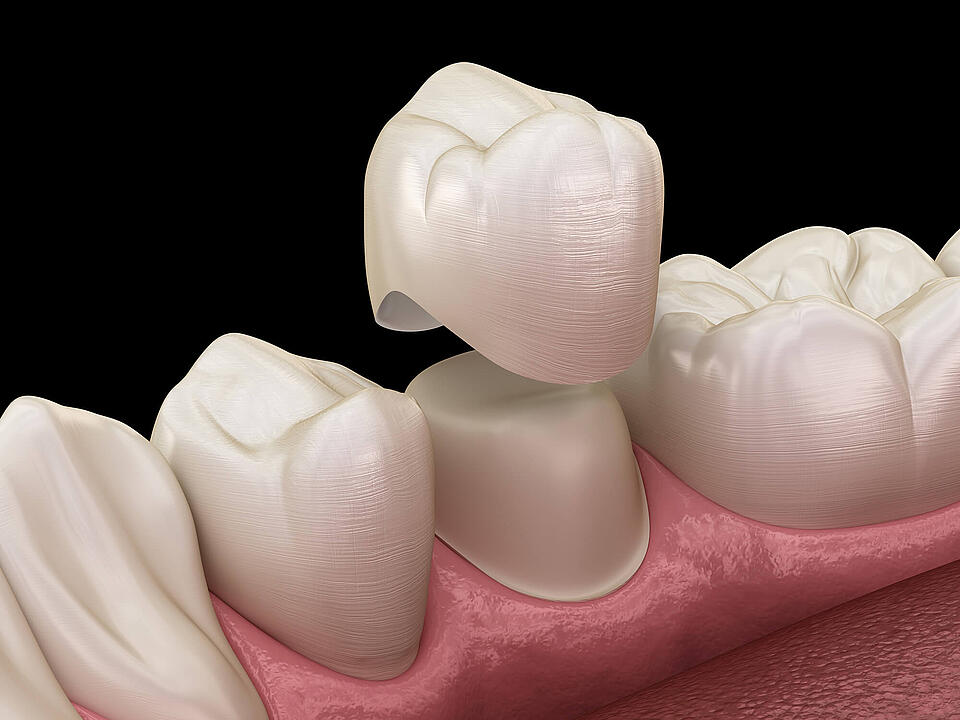 Alternativen zu Zahnimplantaten