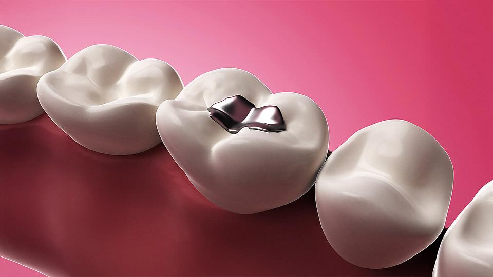 Amalgam