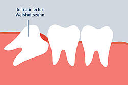 Nach weisheitszahn op nachbluten Weisheitszahn OP