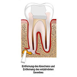 Wurzelspitzenresektion (Entfernung der Entzündung)