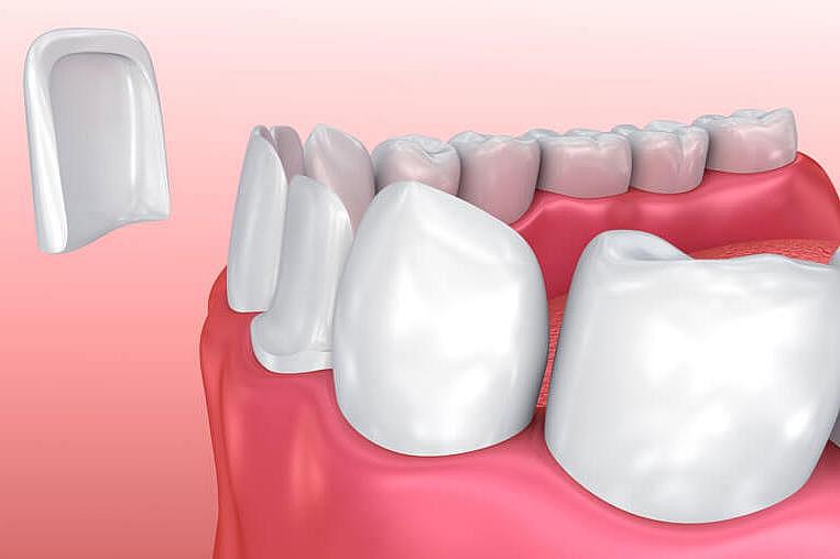 Veneers Zahnverblendung Veneers Zahnverblendung