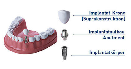 Zahnimplantat Aufbau