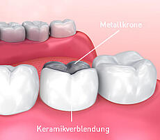 Verblendkrone