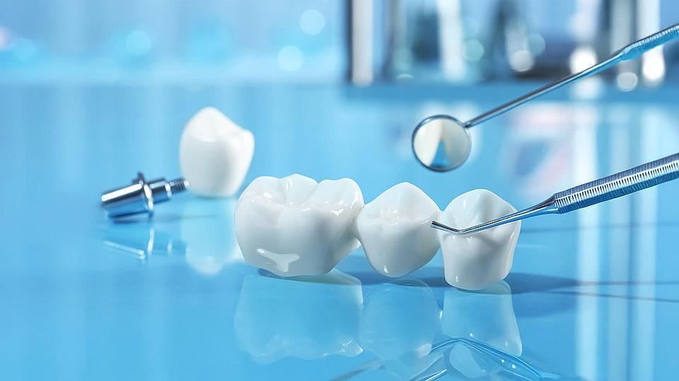 Zahnbrücke und Implantat