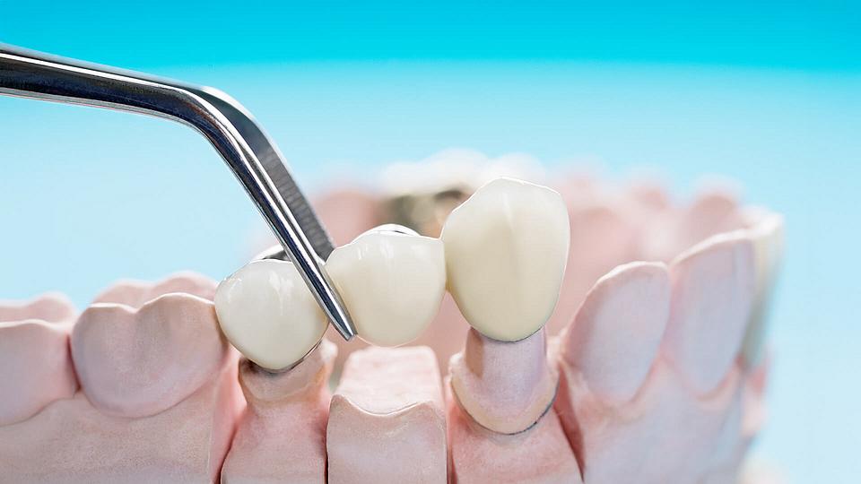Zahnbrücke und Implantat