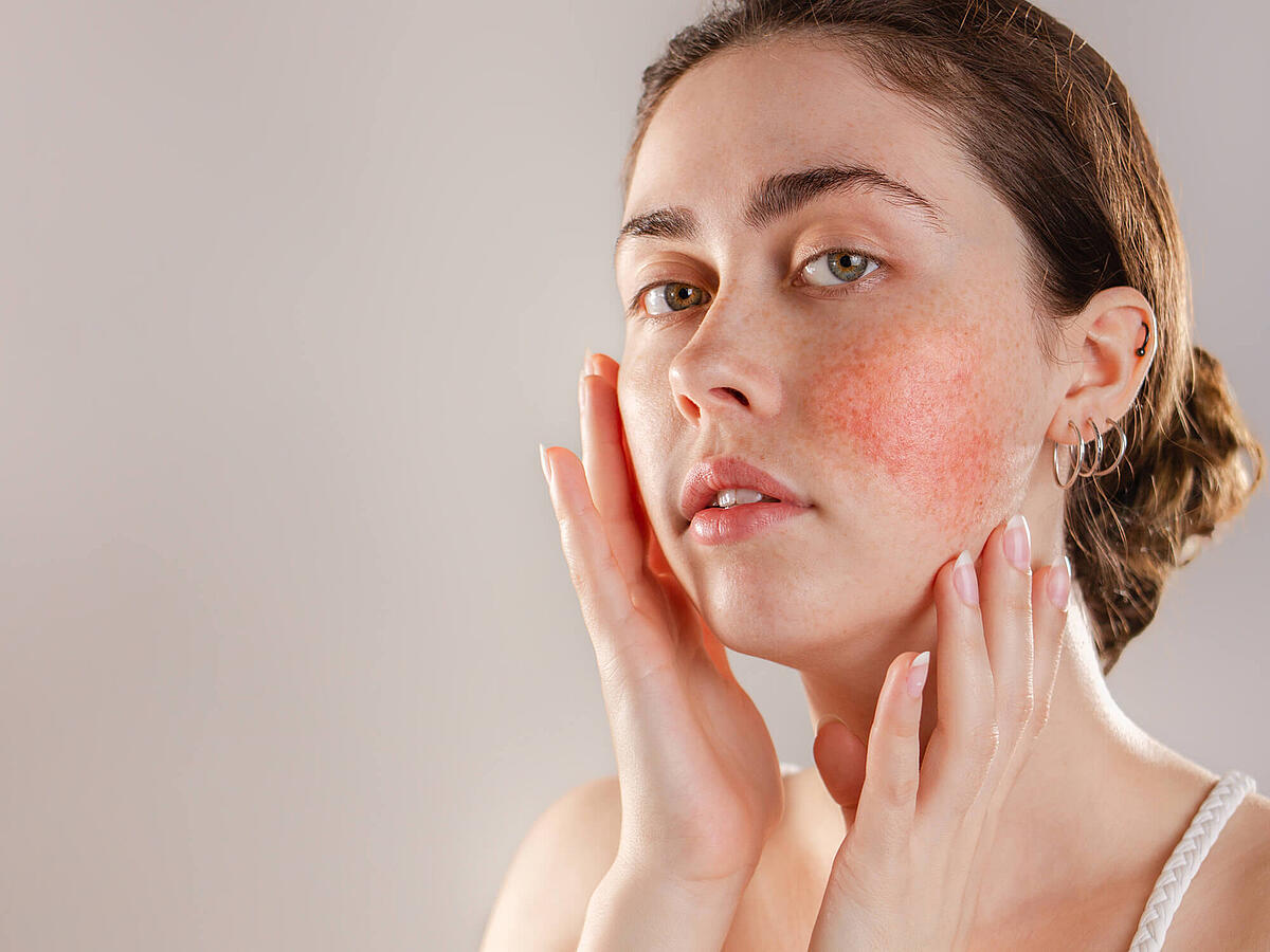 Rosazea: Ursachen, Symptome, Therapie