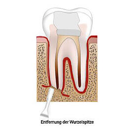 Wurzelspitzenresektion (Entfernung der Wurzelspitze)