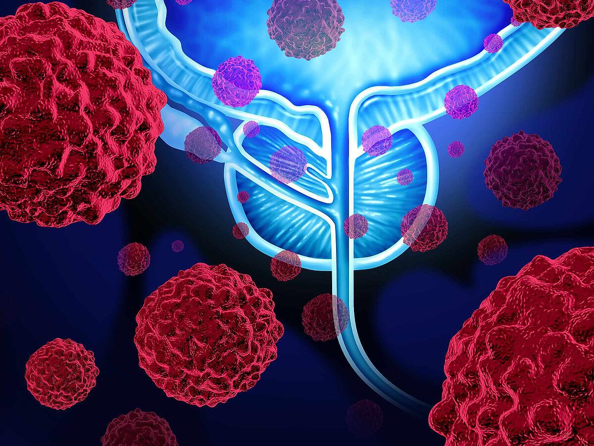 Prostatakrebs: Ursachen, Symptome, Behandlung