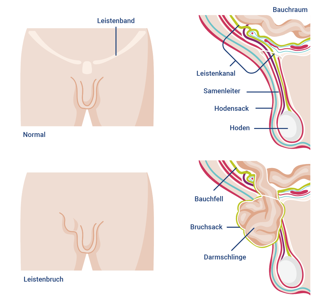 Darstellung Leistenbruch