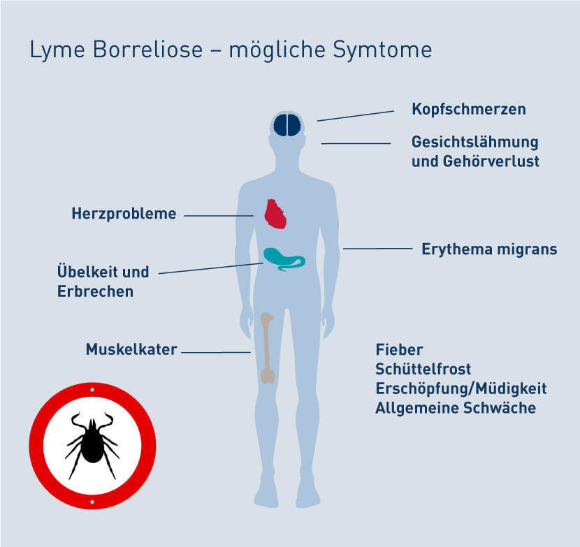 Mögliche Symtome einer Borreliose