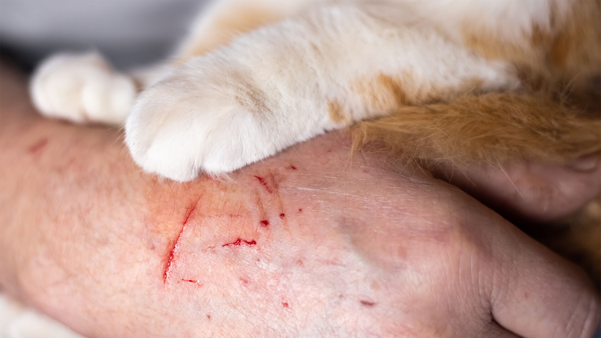 Tollwut beim Menschen