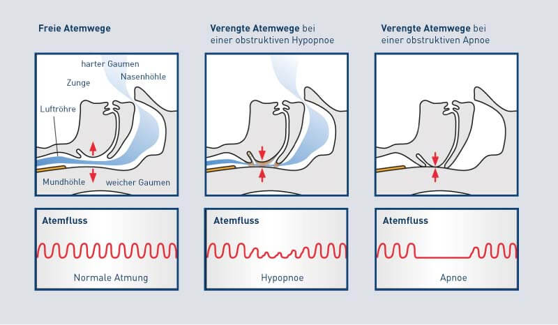 Was passiert bei Schlafabnoe