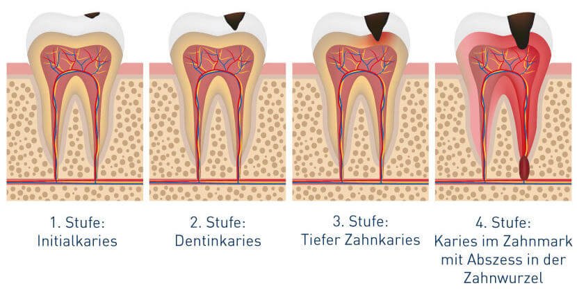 Karies Stadien