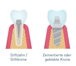 Stiftkrone