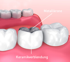 Zahnkrone Arten Behandlung Und Kosten