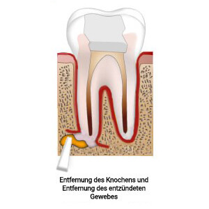 Wurzelspitzenresektion Behandlung Dauer Und Risiken