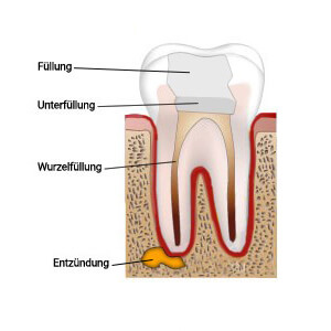 Wurzelspitzenresektion erfahrungen