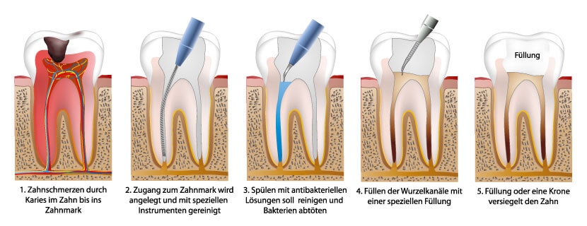 Wurzelbehandlung Ablauf