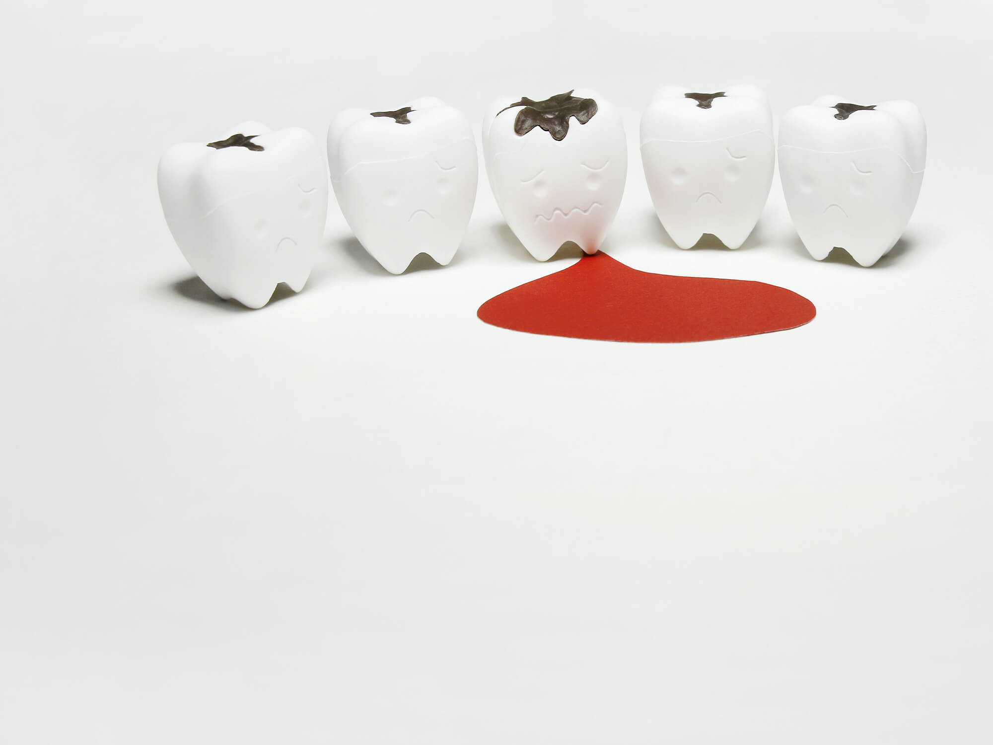 Zahnfleischbluten Ursachen Symptome Behandlung