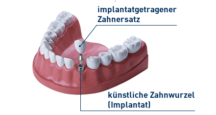 Zahnimplantat