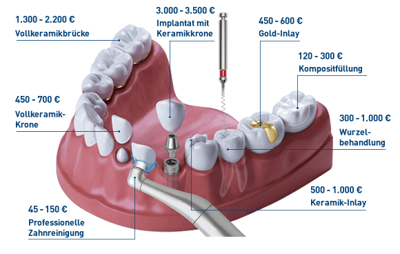 Zahnzusatzversicherung Vergleich